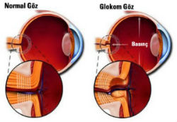 Glokom ile ilişkili yüksek tansiyon ilaçları