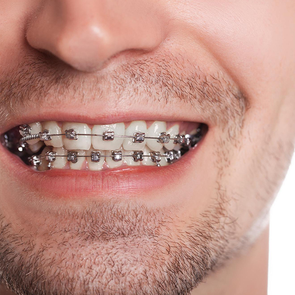 Ortodonti nedir?
