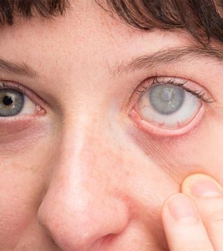 Katarakt ameliyatı ve Göz içi Lensler